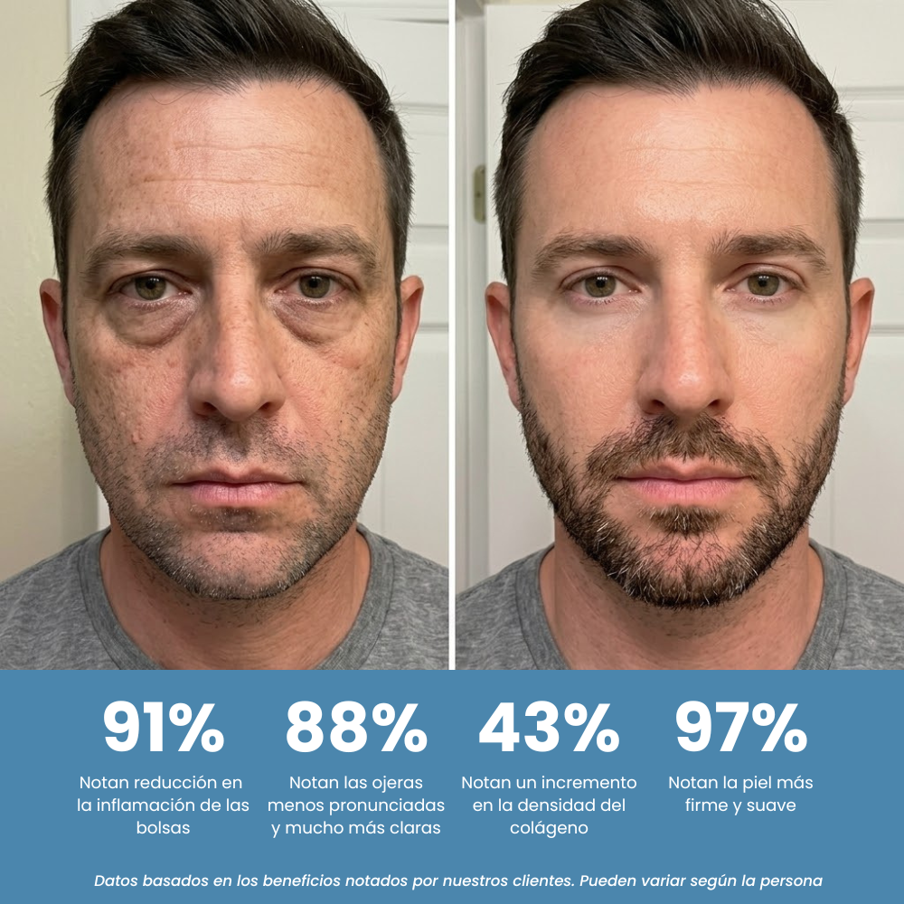 Eye Releaf™ - Gafas Anti Bolsas y Ojeras