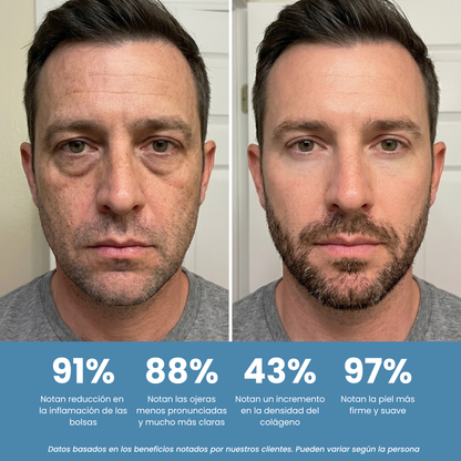 Eye Releaf™ - Gafas Anti Bolsas y Ojeras
